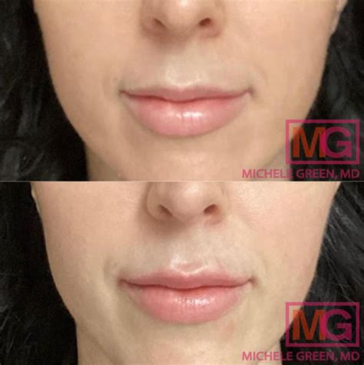 Botox And Lip Filler Before And After Photos