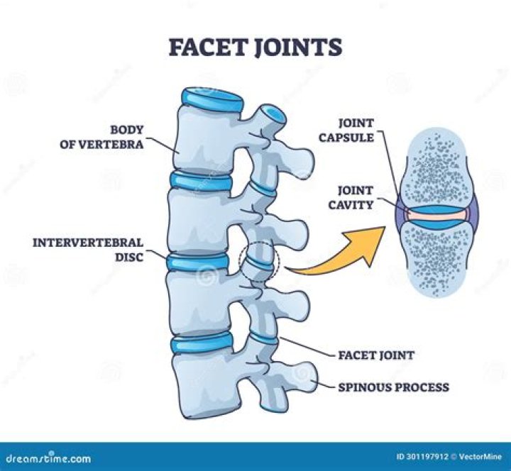 The Ultimate Guide To Understanding Facet Hypertrophy: Definition And Causes